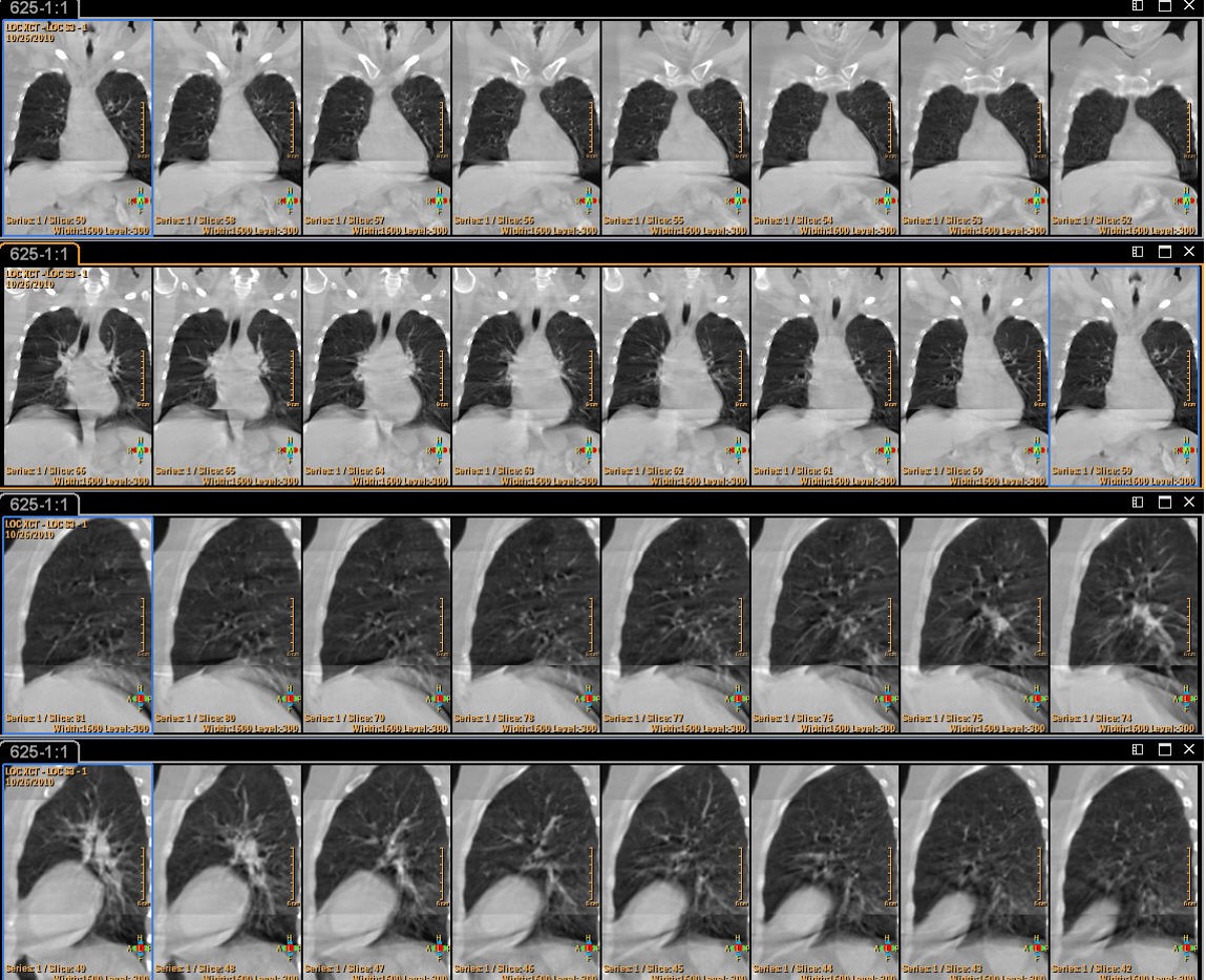 western-nuclear-medicine-lung-scan